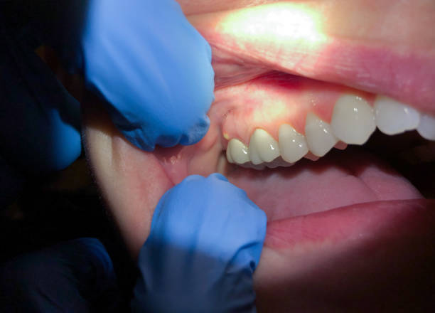Best Emergency Tooth Extraction in Ome, GA