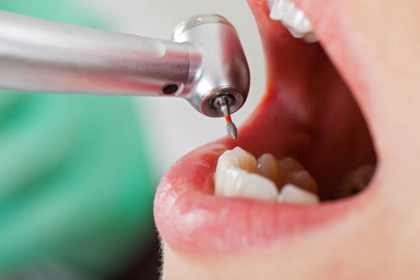 Best Emergency Dental Care for Broken or Chipped Teeth in Ome, GA
